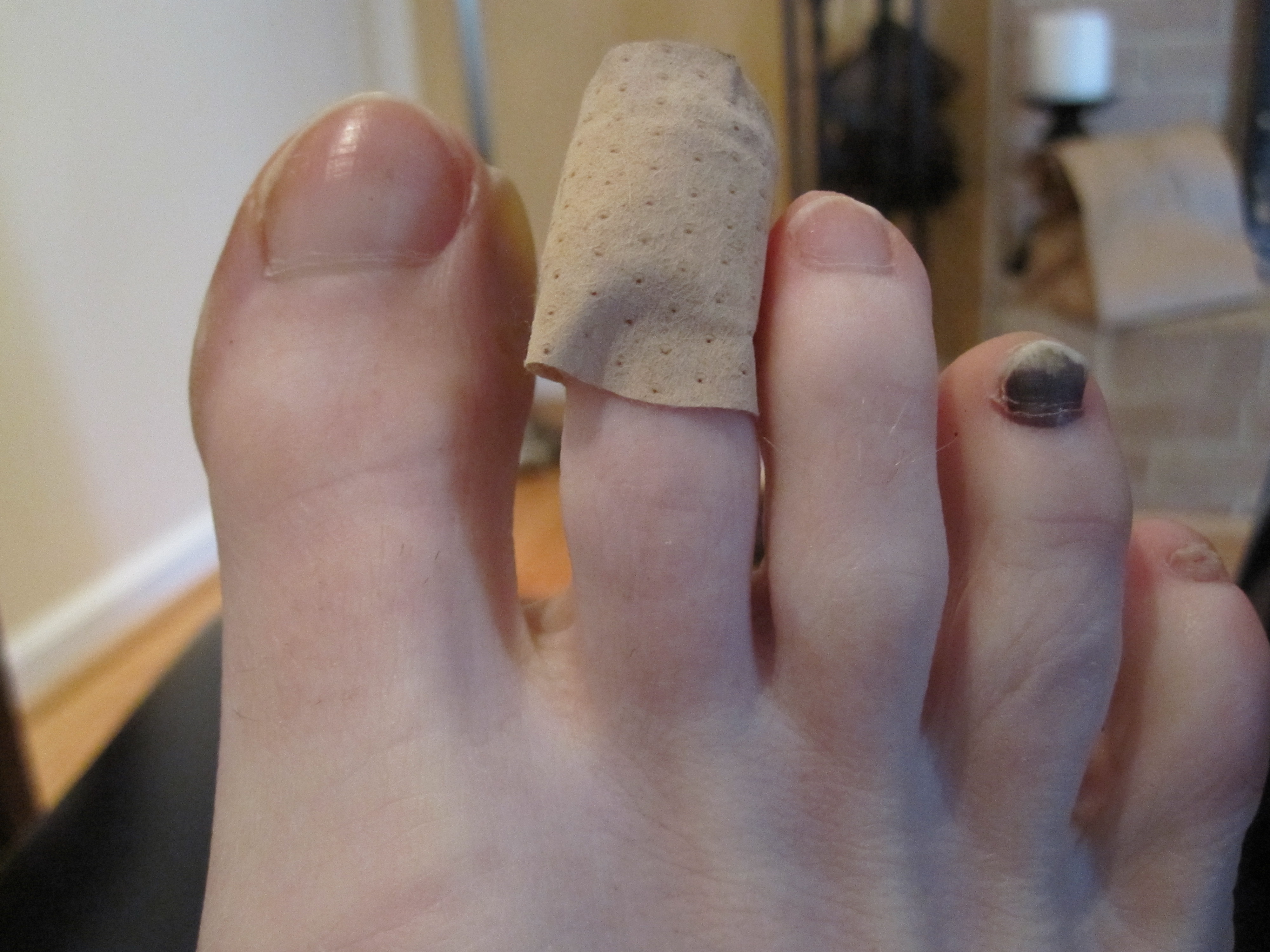 Blisters, Black Toenails and Runner's Feet: Bad & The Ugly (There is Good)