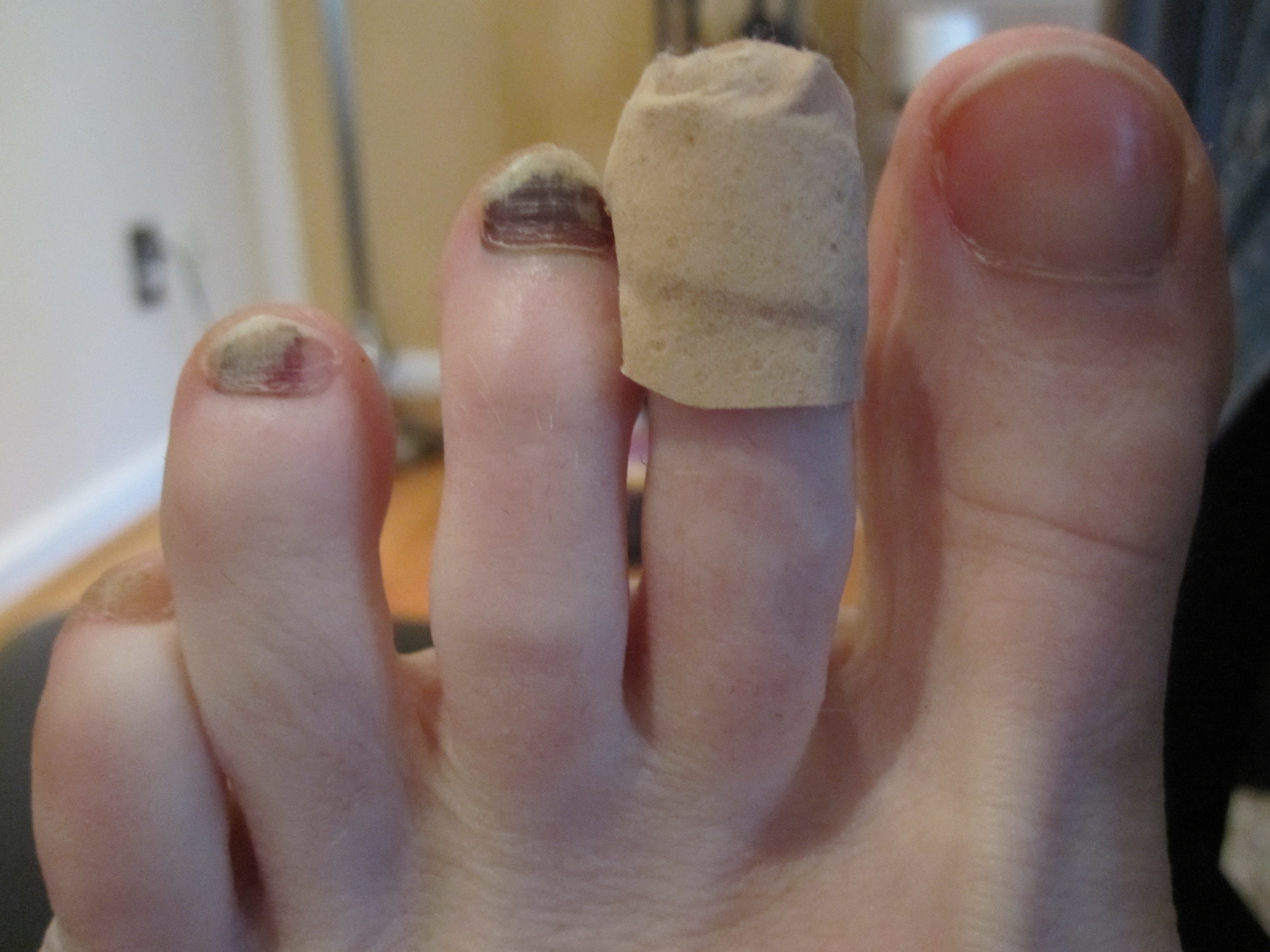 Black Toenail Problems 22